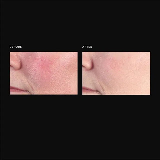 PCA Anti Redness Serum