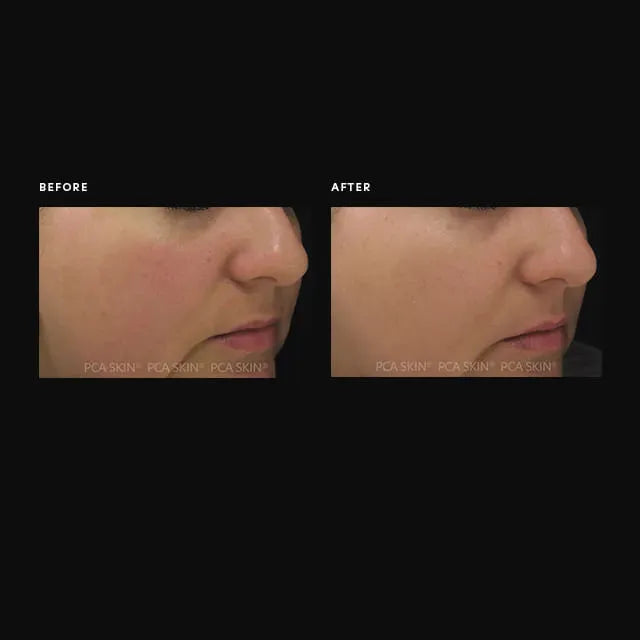 PCA Dual Action Redness Relief