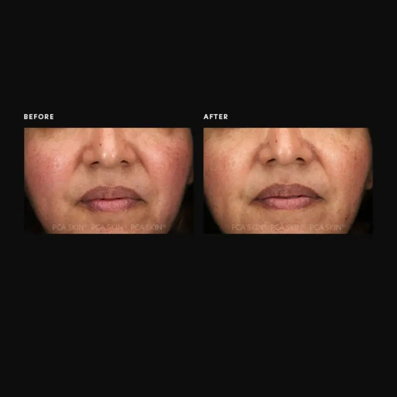 PCA Resurfacing Serum