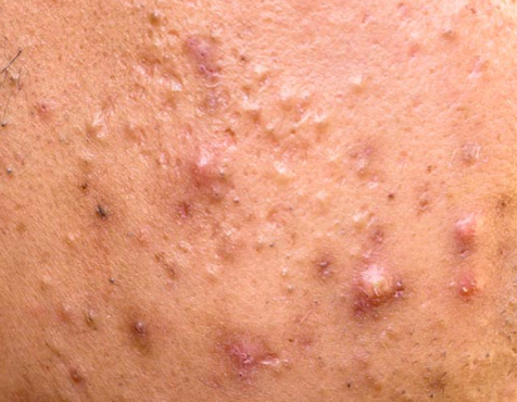 Inflamed Acne