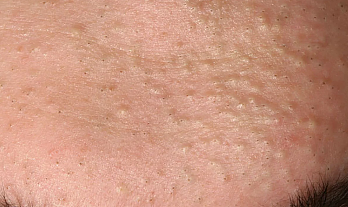 Non-Inflamed Acne